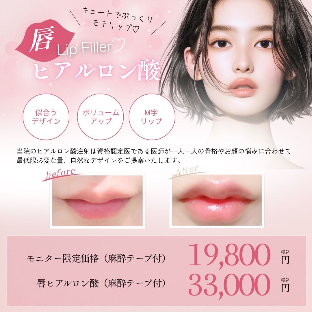 唇ヒアルロン酸