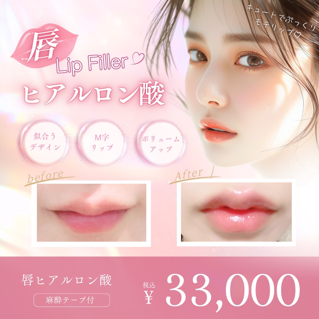 唇ヒアルロン酸