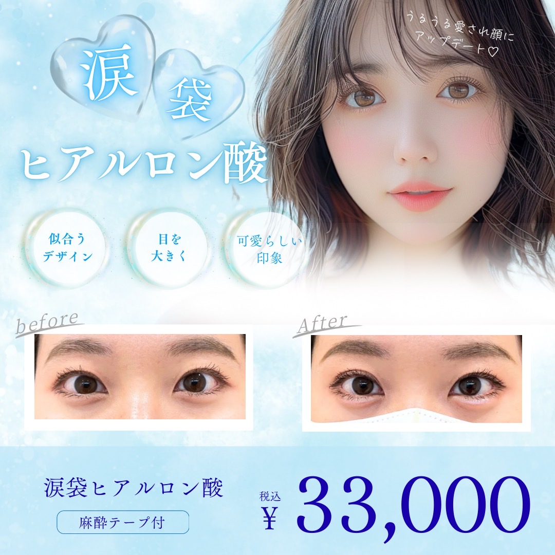 涙袋ヒアルロン酸
